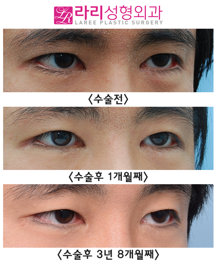 [Rari Plastic Surgery] Before-and-After Photos of Natural Epicanthoplasty Revision Surgery Without Eye Shrinkage or Recurrence image 3