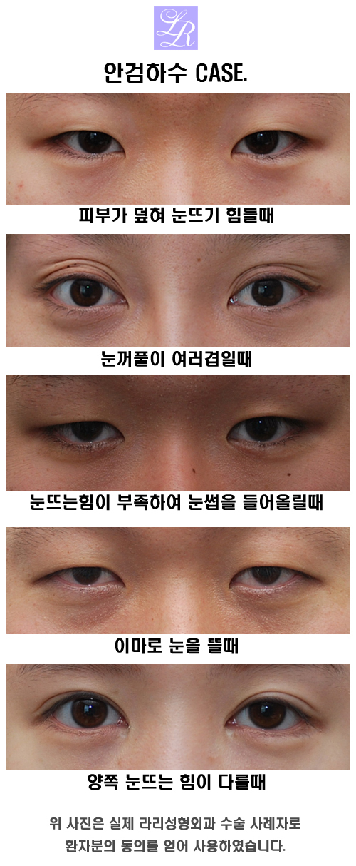 Is eyelid drooping a symptom of ptosis? image 4