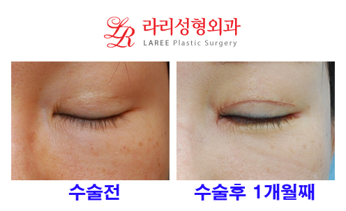 Revision Double Eyelid Surgery (Sausage Correction), Epicanthoplasty, Canthoplasty, Under-Eye Fat Removal, and Aegyo-Sal Fat Grafting image 4