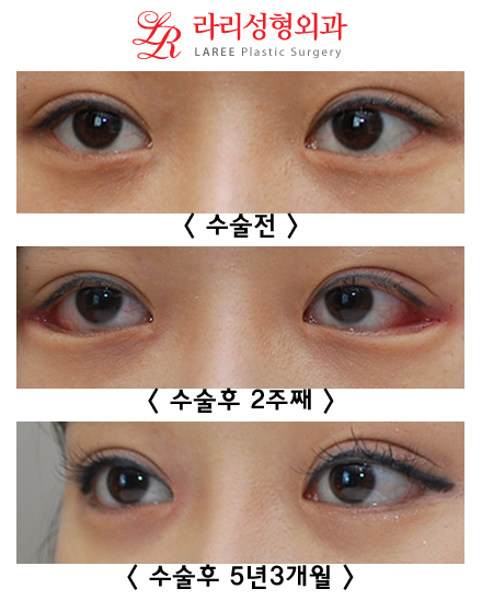 8-Year Long-Term Follow-Up vs. 2-Week Short-Term Follow-Up in the Same Patient (Lateral Canthoplasty & Revision Lateral Canthoplasty) image 3