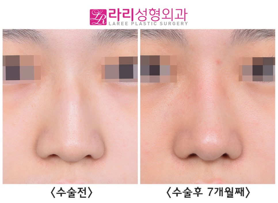 [라리성형외과] 선천성 매부리코, 첫코성형으로 고민하지 말고 매끄럽게 바꾸자 관련 이미지 5