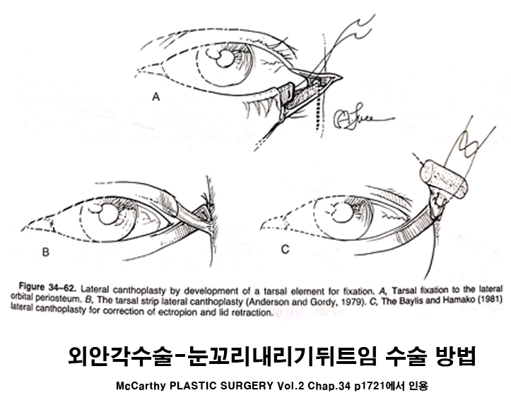 눈 뒤트임에 대한 오해 (feat. 부작용?) 관심있다면 꼭 봐주세요! 관련 이미지 9
