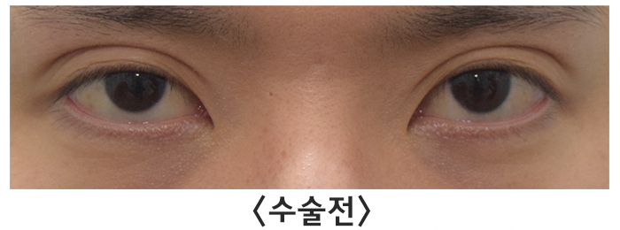 [라리성형외과] 여러 가지 쌍꺼풀 생기는 눈 무쌍으로 바꿔드립니다. 관련 이미지 2