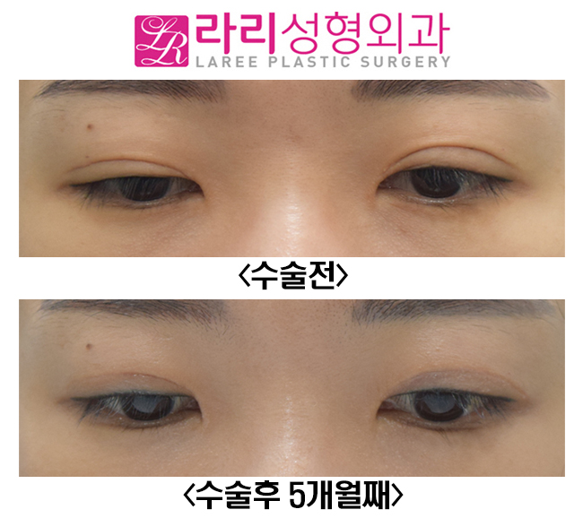 [라리성형외과] 눈매교정이 함께 필요한 쌍꺼풀재수술, 비대칭 눈교정 전후사진 관련 이미지 3