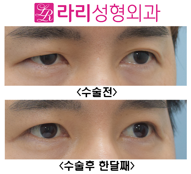 [Larie Plastic Surgery] Surgery to Remove Double Eyelids and Short-Term One-Month Progress Before and After Eye Correction Surgery image 3