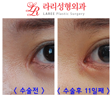 앞트임흉터제거 및 앞트임복원/앞트임재건의 효과를 알아보자! 관련 이미지 2