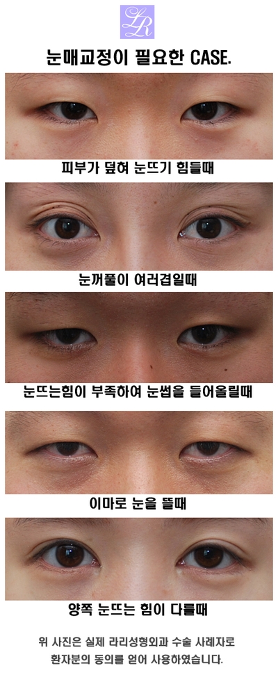 Small Eyes Surgery That Makeup Can’t Fix - Big-Eye Surgery image 6