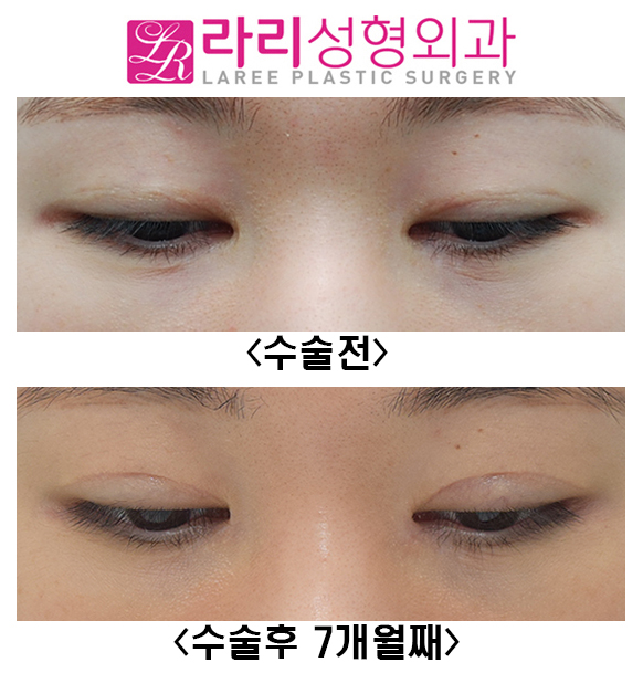 [라리성형외과] 쌍꺼풀재수술, 앞트임복원, 뒤트임재수술, 눈밑지방재배치재수술 전후 관련 이미지 3