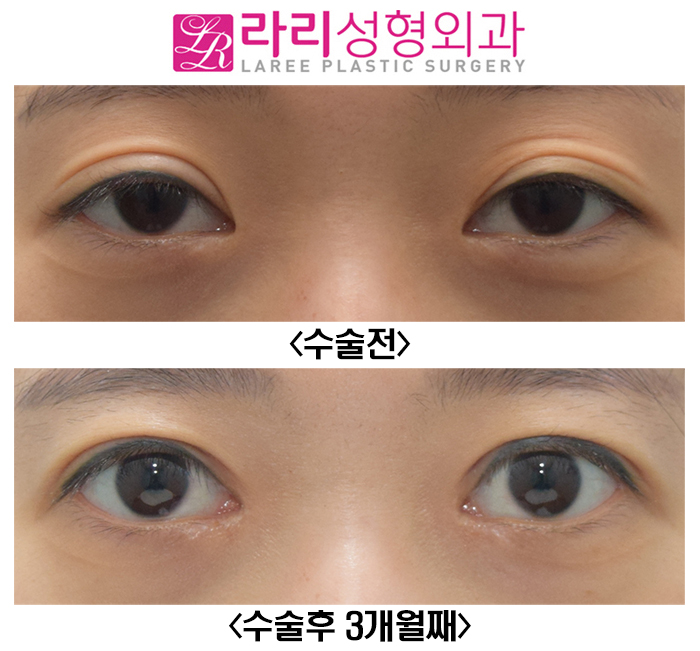 [Rari Plastic Surgery] Reoperation for a Loosened Double Eyelid, with Ptosis Correction image 1