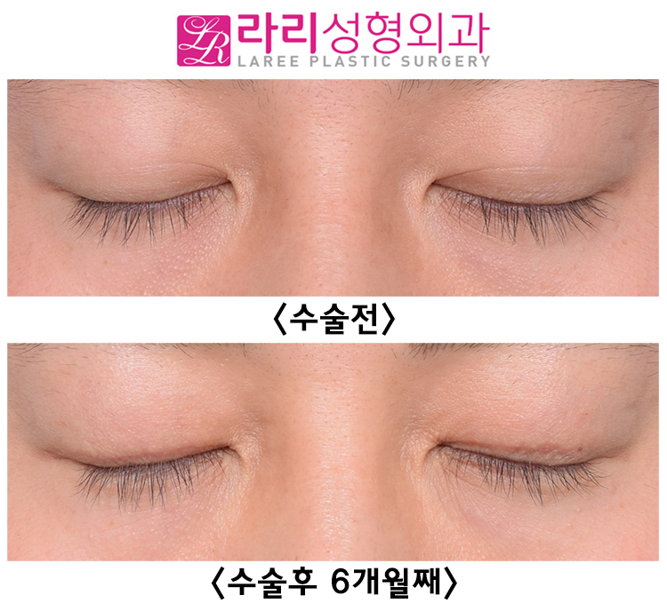 [Rari Plastic Surgery] Double-Eyelid Removal Surgery That Corrects Three-White Eye Without Lower Eyelid Surgery image 4