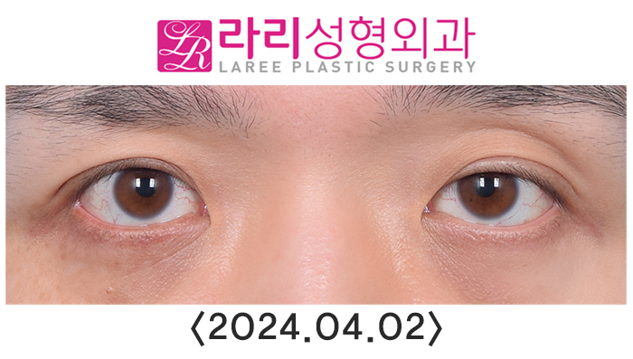 [Lari Plastic Surgery] Double Eyelid Removal Surgery and Upper Eyelid Fat Grafting Surgery: Comparing Recovery and Swelling Over 6 Months image 1