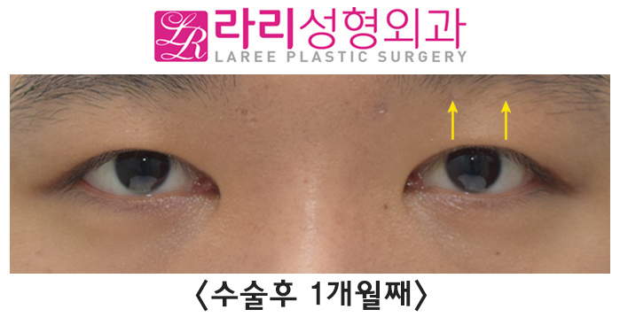 [Rari Plastic Surgery] Causes of Uneven Eye Size After Double Eyelid Removal Surgery, Cases That Naturally Even Out, Before-and-After Photos image 4