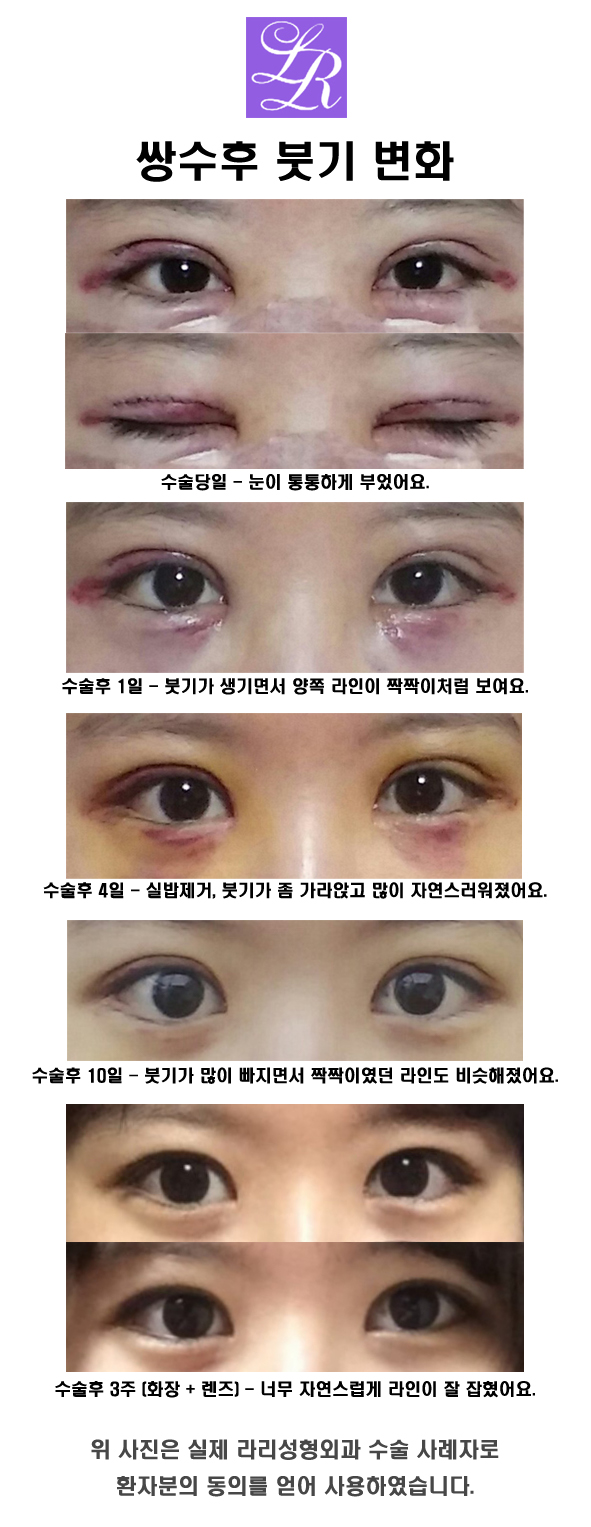 Swelling After Suture Removal Following Double Eyelid Surgery: Curious image 2