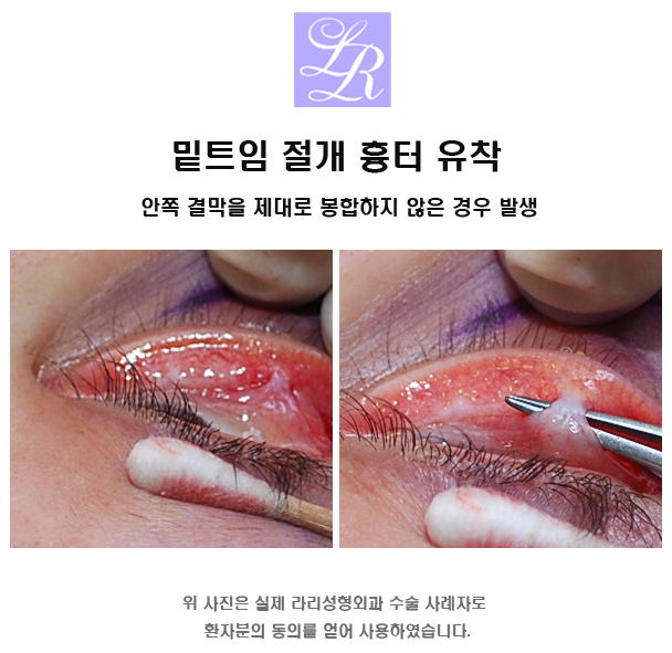 If You're Curious About Side Effects of Lower Eye Corner Surgery (feat. Conjunctival Edema) image 7