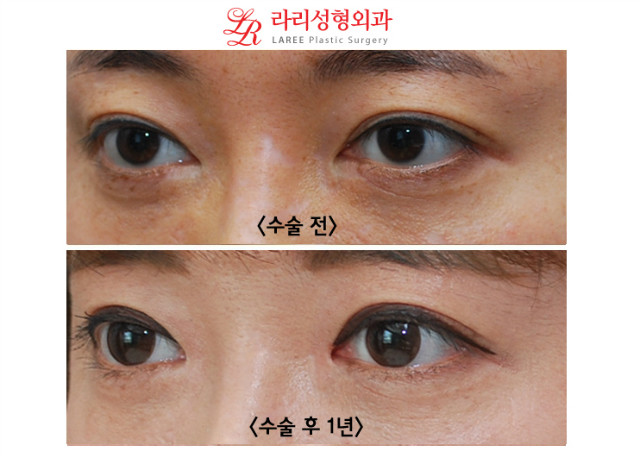 앞트임 복원 전후사진 (수술 2개월후와 1년후) 관련 이미지 5