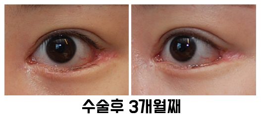 속눈썹 찌름 - 안검내반 교정 최소절개 흉터에 대해 관련 이미지 8