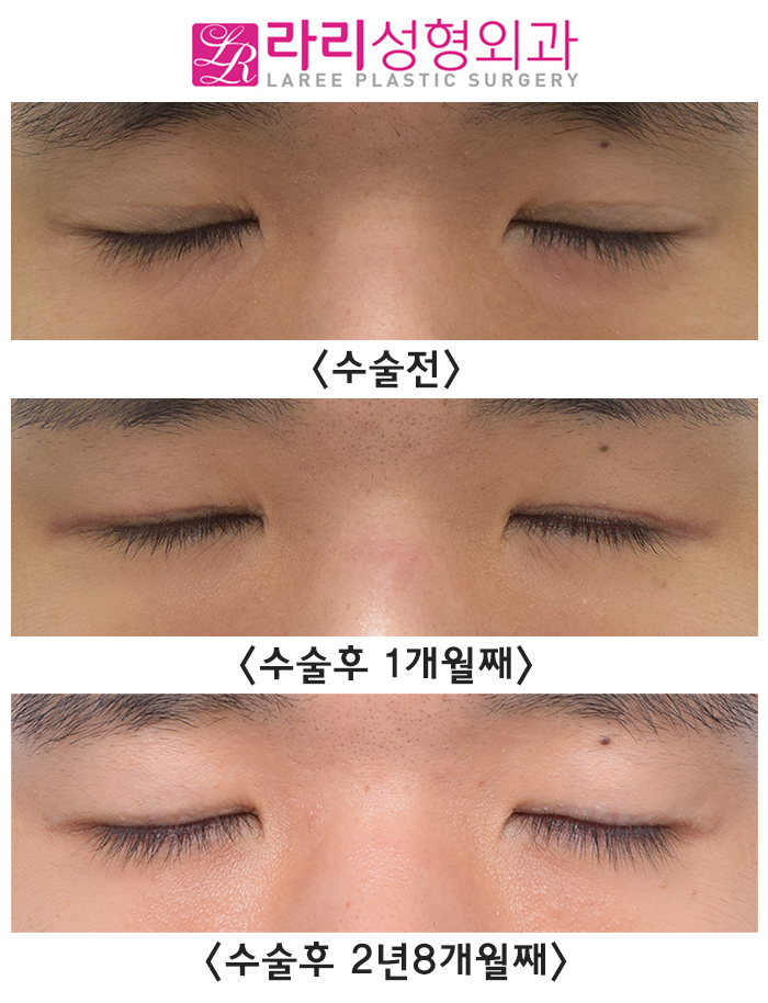 [Lari Plastic Surgery] Removing Eyelid Creases: Eyes Not Closing Fully, Side Effects, Recovery, Before-and-After Photos image 4
