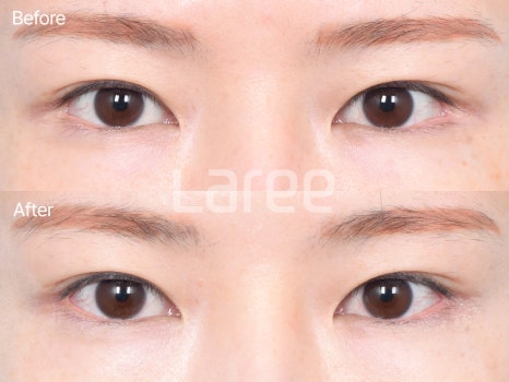 [LaLi Plastic Surgery] Outer Canthus Lowering Surgery, If It’s a Revision Surgery, It Must Be Done at a Place That Does It Well. image 6