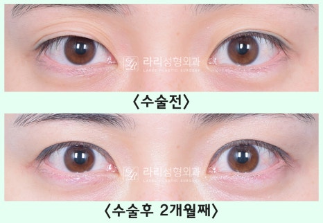 [Lari Plastic Surgery] Removing a Visible Double Eyelid (Double Eyelid Reversal Surgery), From Natural Double Eyelids to Surgical Double Eyelids: A to Z image 12