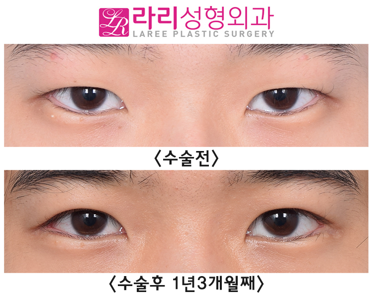 [Lari Plastic Surgery] Incisional Eyelid Correction + Lateral Canthoplasty for Men, and Before-and-After Photos of Hump Nose Osteotomy Surgery Using Ear Cartilage and Septal Cartilage image 1