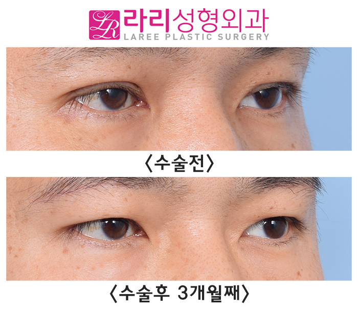 [라리성형외과] 절개 눈매교정 후 급속교정, 6개월 기다리지 않고 일주일 만에 쌍꺼풀없애기 관련 이미지 4