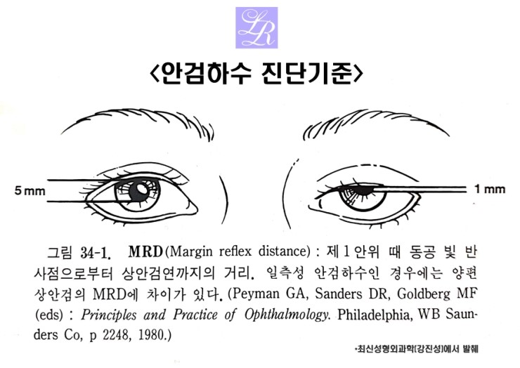 남자눈매교정, 무쌍이 대세 관련 이미지 3