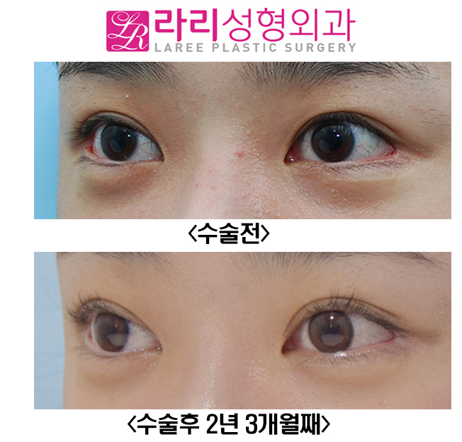 [라리성형외과] 최소한의 뒤트임 복원수술로 최대한의 효과를(+쌍수 짝짝이 교정) 관련 이미지 2