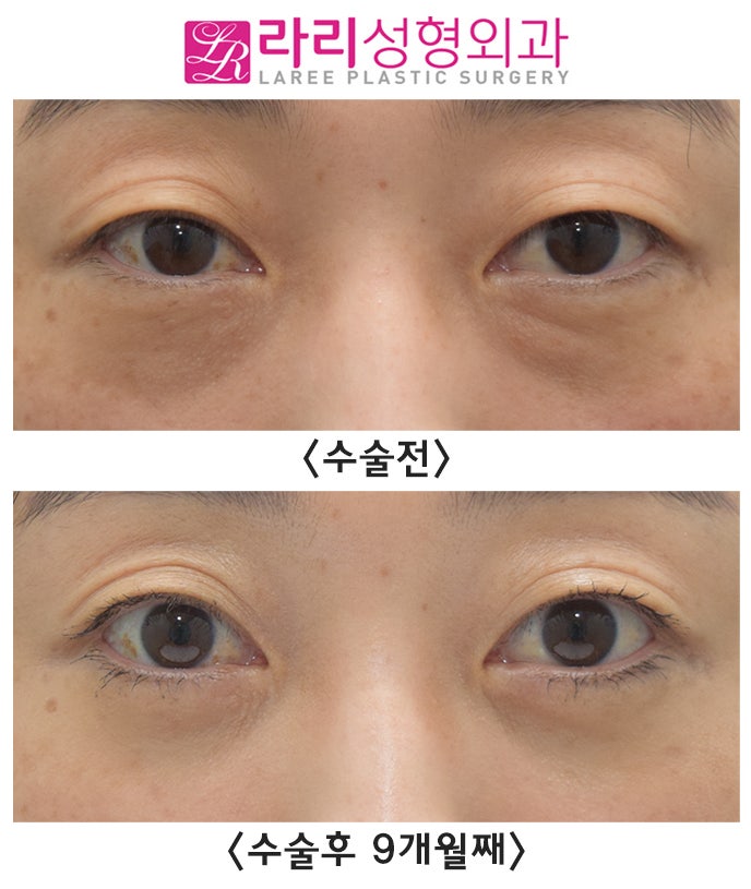 [Lari Plastic Surgery] Lower Blepharoplasty? Under-Eye Fat Repositioning Surgery? Which Surgery Do I Need? image 1
