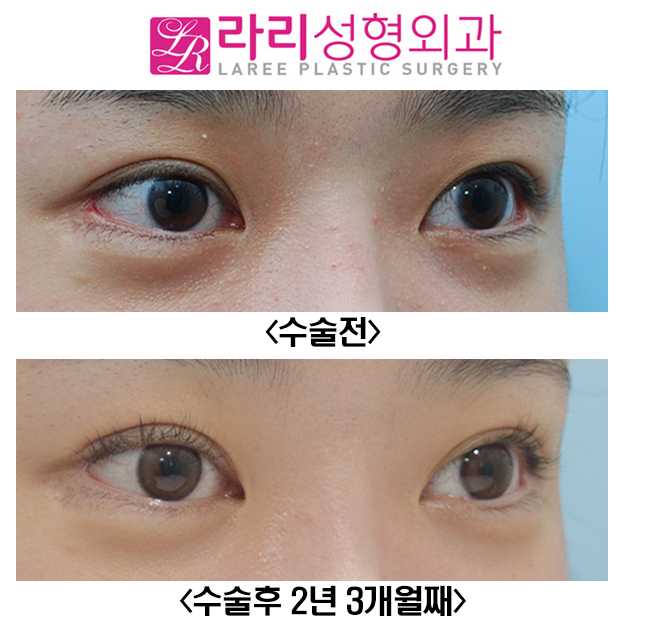 [라리성형외과] 최소한의 뒤트임 복원수술로 최대한의 효과를(+쌍수 짝짝이 교정) 관련 이미지 1