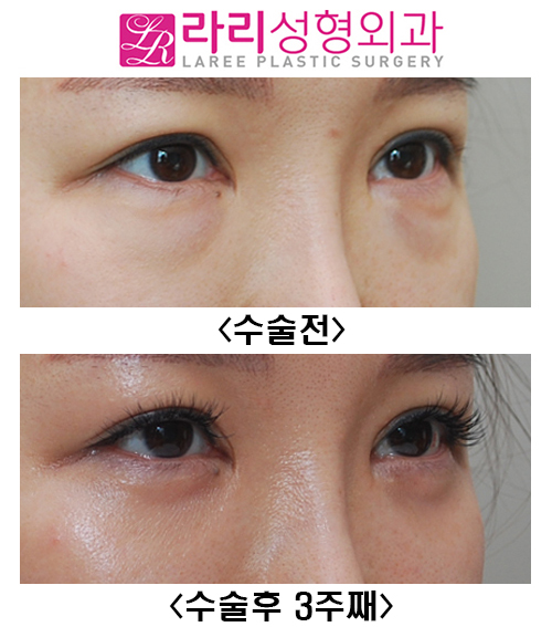 [라리성형외과] 눈밑지방재배치 수술후 3주째 경과 관련 이미지 4