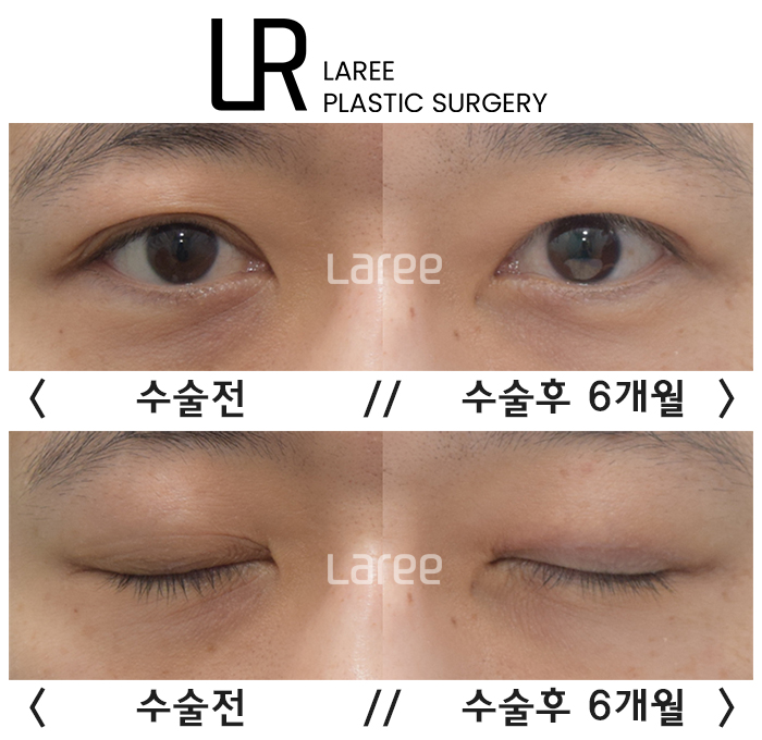 [라리성형외과] 쌍꺼풀수술은 괜찮은데 쌍꺼풀없애는수술은 괜찮지 않다고 ? 관련 이미지 5