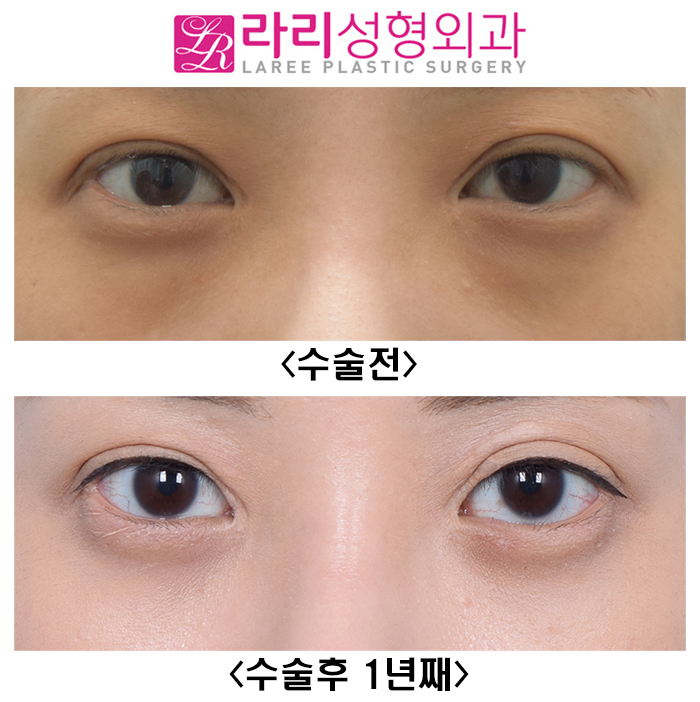 [Lari Plastic Surgery] Not a Lower Eyelid Fat Repositioning Surgery That Quickly Comes Back, but a Long-Lasting One image 1