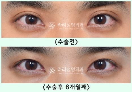 [Lari Plastic Surgery] Removing a Visible Double Eyelid (Double Eyelid Reversal Surgery), From Natural Double Eyelids to Surgical Double Eyelids: A to Z image 9