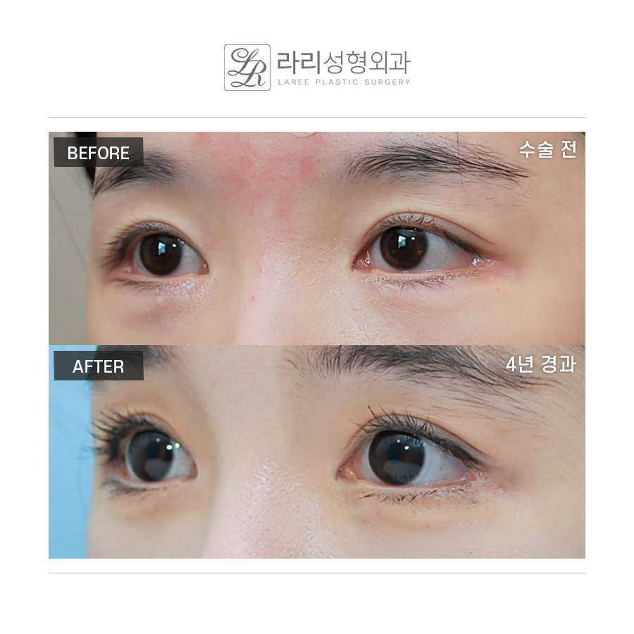 [라리성형외과] 밑트임수술 3년 이상 장기경과 전후사진 관련 이미지 3