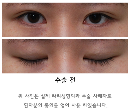 Swelling and Results Judged from Photos in Non-Incision Eye Correction Reviews image 5