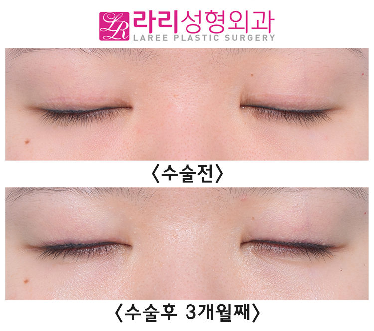 [라리성형외과] 쌍꺼풀없애는수술에 대하여 관련 이미지 4