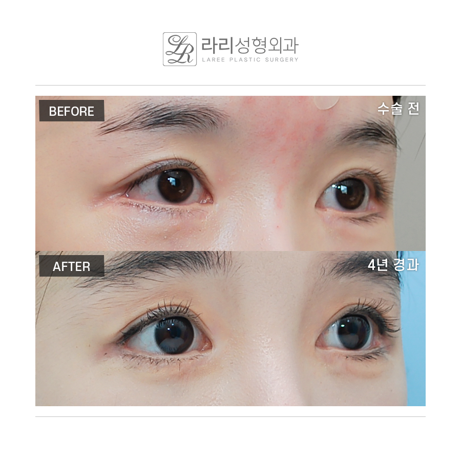 [라리성형외과] 밑트임수술 3년 이상 장기경과 전후사진 관련 이미지 2