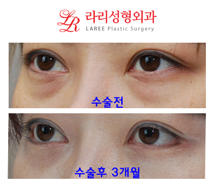뒤트임, 눈밑지방재배치 동시에 가능? 관련 이미지 2