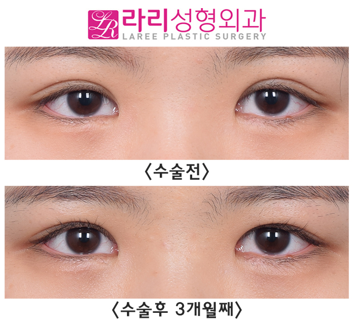 [Rari Plastic Surgery] Making Small Eyes Look Bigger with Revision Double Eyelid Surgery and Sausage Correction image 1