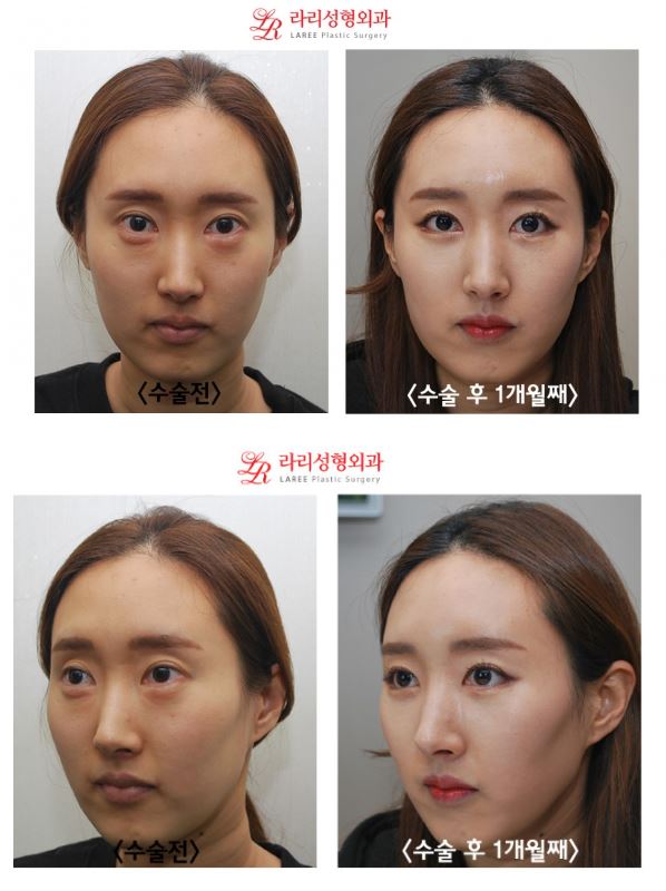 [Big-Eyed Canthoplasty] Revision Surgery for Lateral Canthoplasty to Lower the Outer Eye Corner / Revision Surgery for Lowering the Outer Eye Corner, Before-and-After Photos of Under-Eye Fat Repositioning image 1