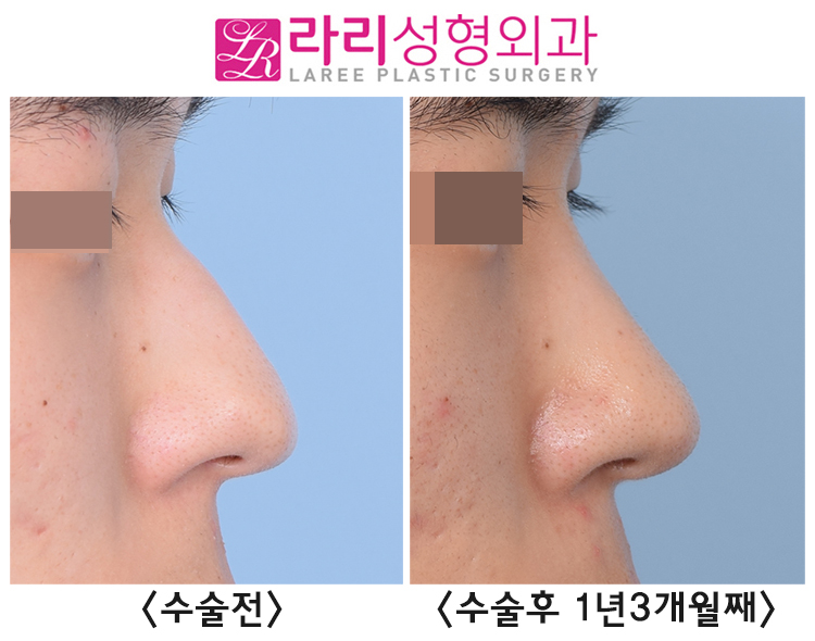 [Lari Plastic Surgery] Incisional Eyelid Correction + Lateral Canthoplasty for Men, and Before-and-After Photos of Hump Nose Osteotomy Surgery Using Ear Cartilage and Septal Cartilage image 5