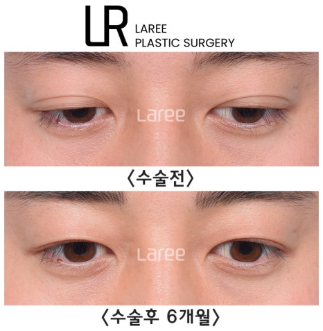 [라리성형외과] 쌍꺼풀없애는 무쌍 수술, 쌍꺼풀라인 낮추기가 아닙니다. (완전무쌍과 무쌍속쌍 그 차이) 관련 이미지 10