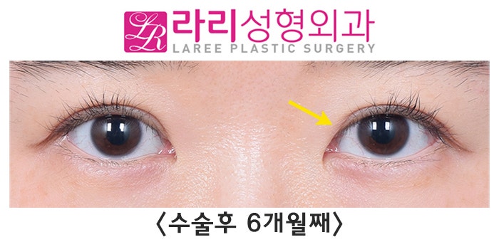 [Lari Plastic Surgery] Changes in Double Eyelid Line Over Time After Revision Surgery for Loosening Side Effects image 4
