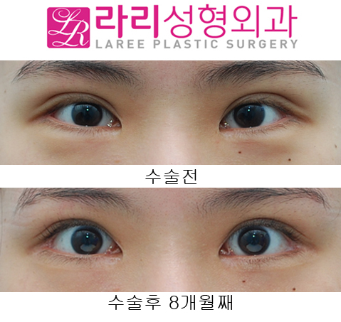 [라리성형외과] 쌍꺼풀재수술 소세지교정, 뒤트임재수술 관련 이미지 1