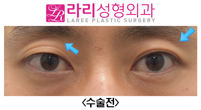 [라리성형외과] 쌍꺼풀없애기와 함께 한 윗눈꺼풀 패임 교정, 눈두덩이(Roof) 지방이식수술 전후사진 관련 이미지 1