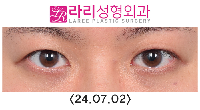 [라리성형외과] 쌍꺼풀없애는수술 후 필요에 의한 재교정과 회복 과정 기간별 사진 관련 이미지 6
