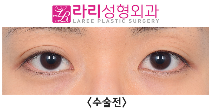 [라리성형외과] 겹주름 쌍꺼풀을 잘 없애려면 피할 수 없는 상안검외반, 좋아질 수 있어요. 관련 이미지 1
