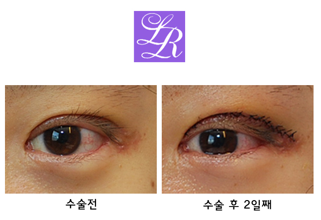 Upper Eyelid Double Eyelid Surgery, Eyelid Eversion (Mucosal Show, Eyelash Elevation) - Rapid Correction image 1