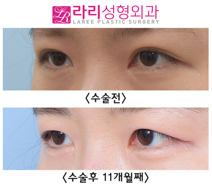 [라리성형외과] 지겨운 소세지 쌍꺼풀 싫어요, 자연스러운 속쌍 쌍꺼풀재수술 관련 이미지 3