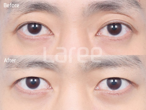[Lari Plastic Surgery] Eyelid Fat Grafting for Improving the Eyelid Hollow: Incision Method vs. Non-Incision Method image 3